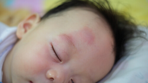皮膚の病気 つだ小児科クリニック 小児科一般 アレルギー科 乳幼児健診 予防接種