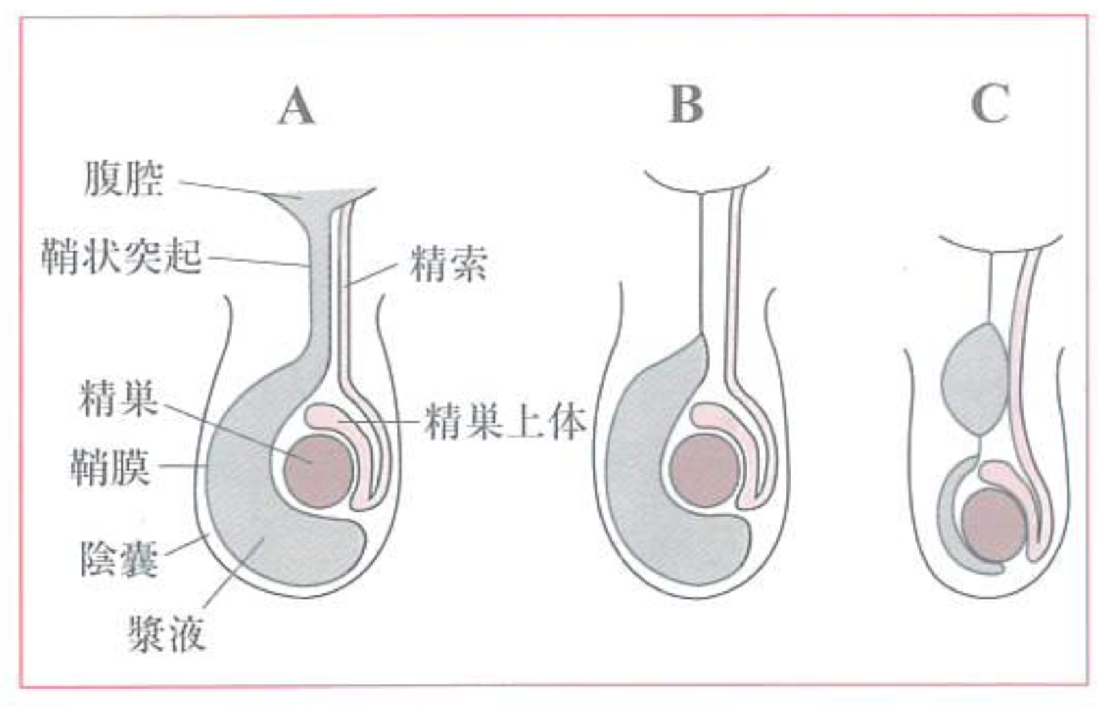 精巣水瘤 陰嚢水腫 精索水瘤 つだ小児科クリニック 小児科一般 アレルギー科 乳幼児健診 予防接種