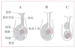 精巣水瘤（陰嚢水腫）、精索水瘤