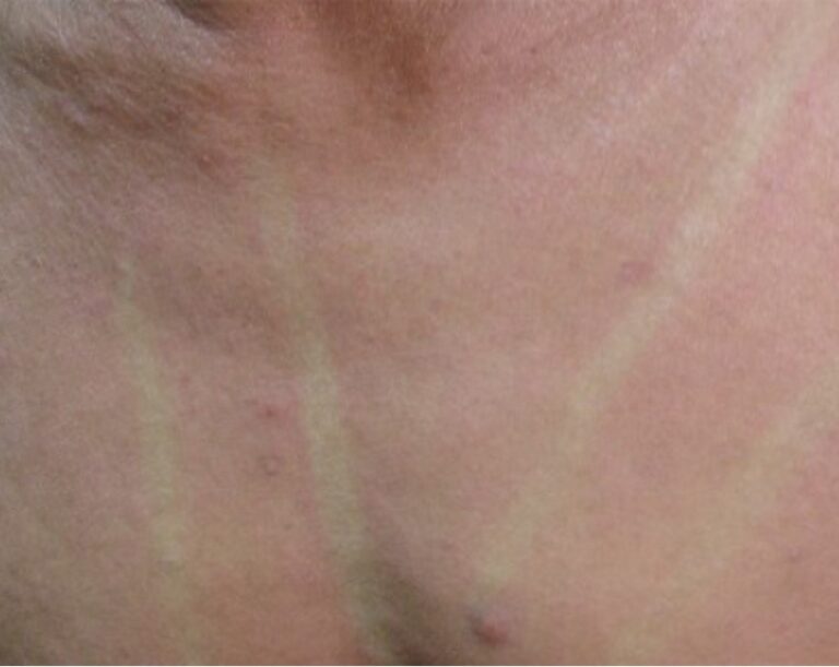 白色描記症と赤色描記症 つだ小児科クリニック 小児科一般・アレルギー科・乳幼児健診・予防接種